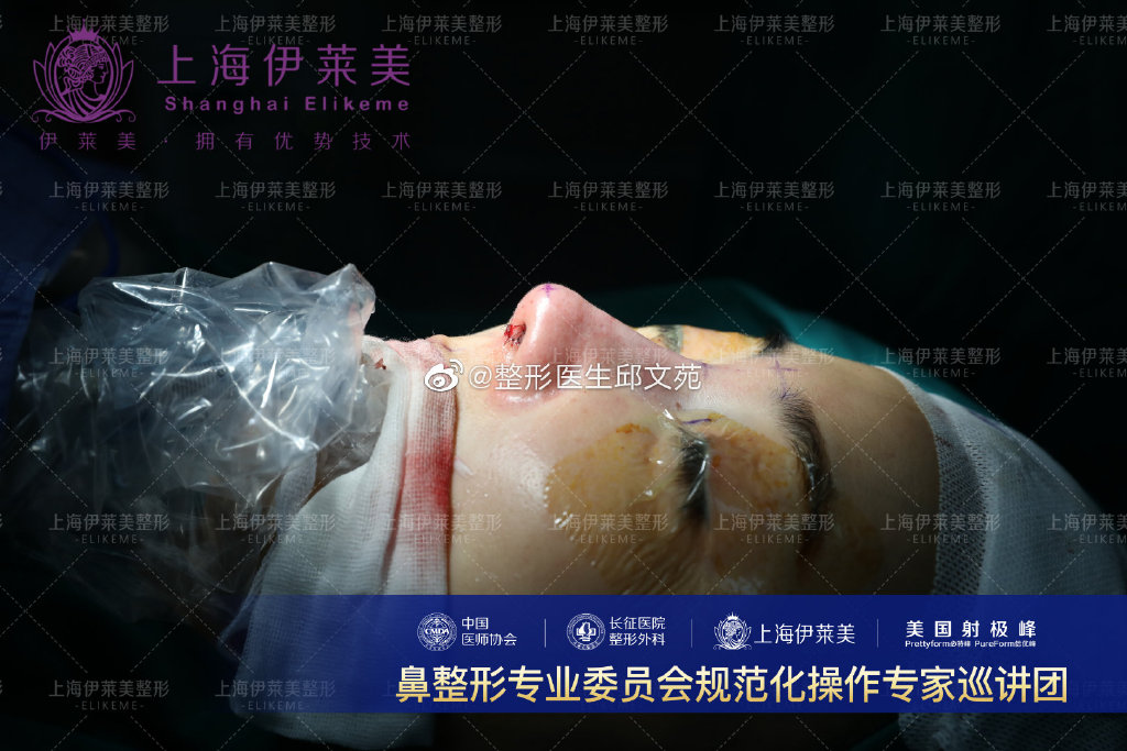 邱文苑鼻綜合案例