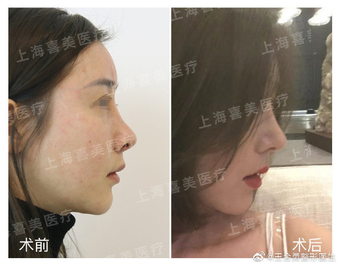 王會勇鼻綜合案例