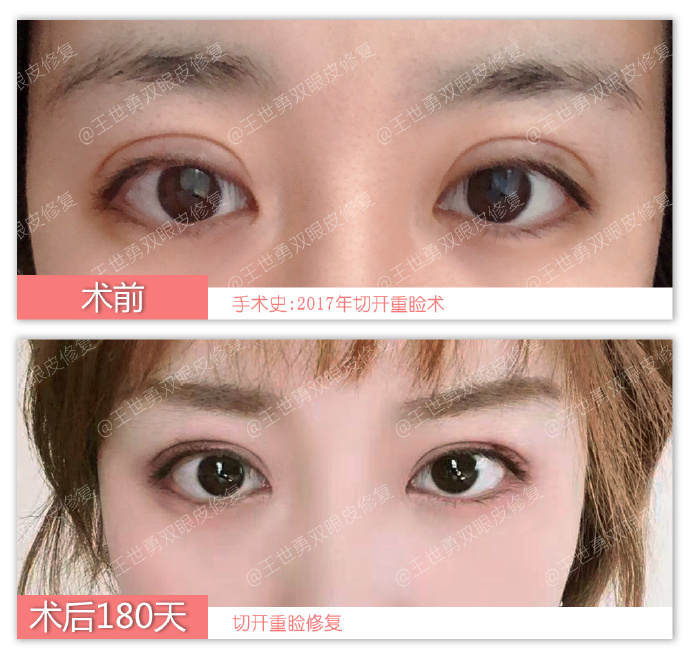 王世勇雙眼皮修復案例