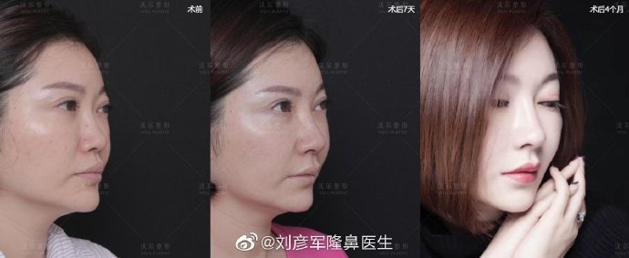 劉彥軍隆鼻案例