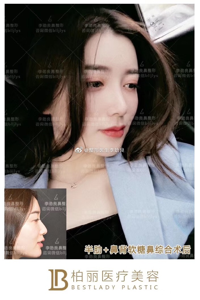 李勁良隆鼻案例