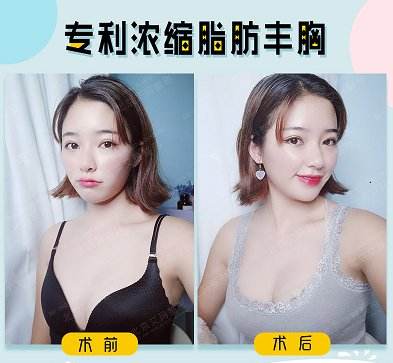 韋元強(qiáng)脂肪豐胸案例