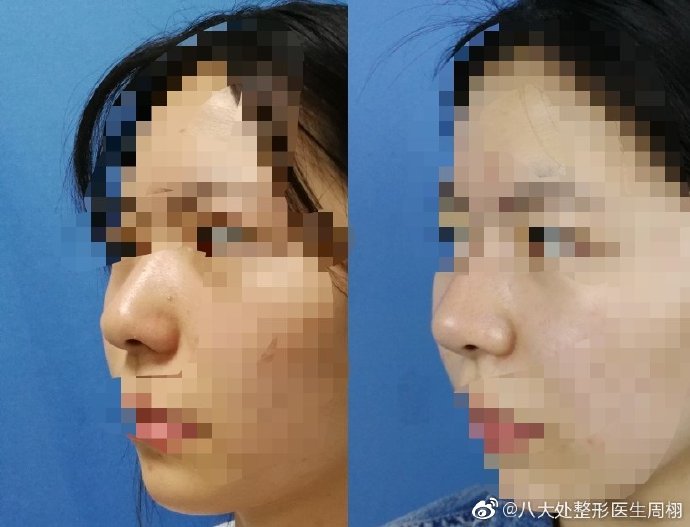 周鼻綜合案例
