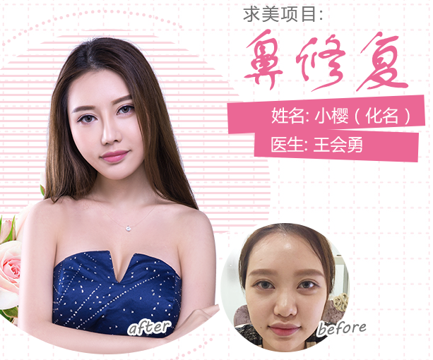 王會勇鼻修復案例