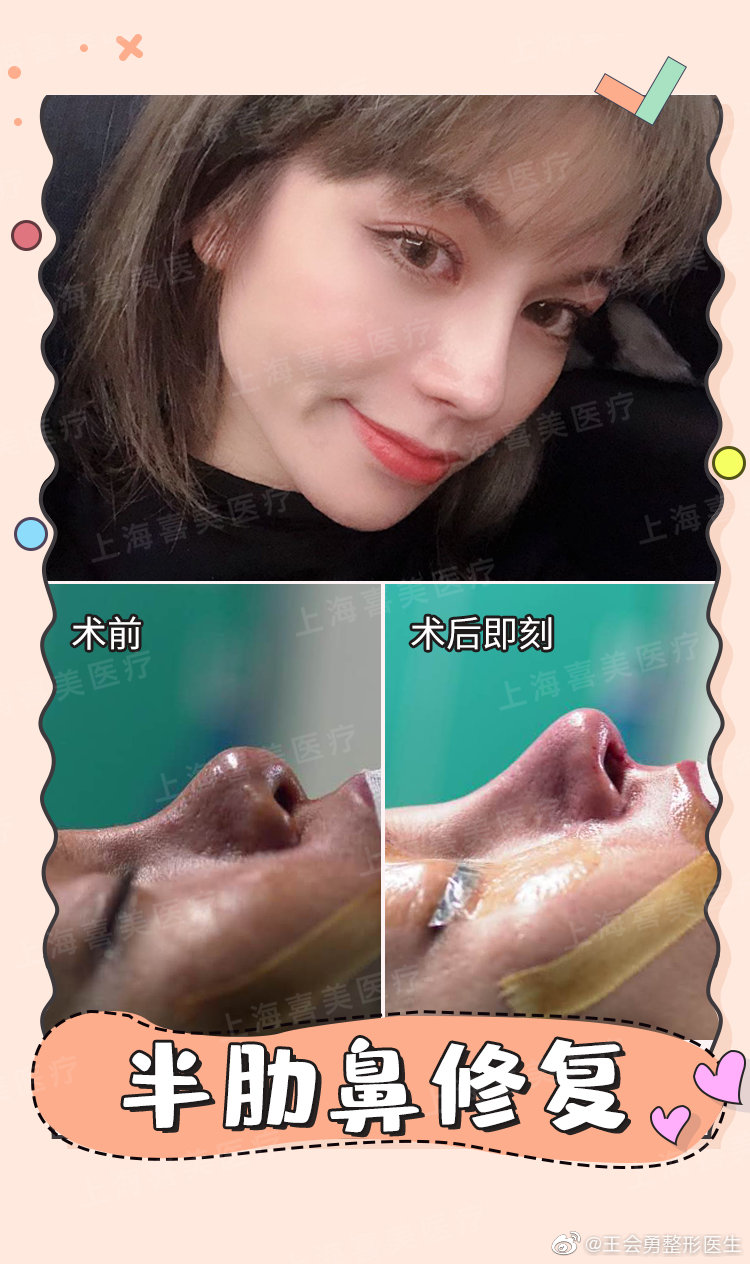 王會勇鼻修復案例
