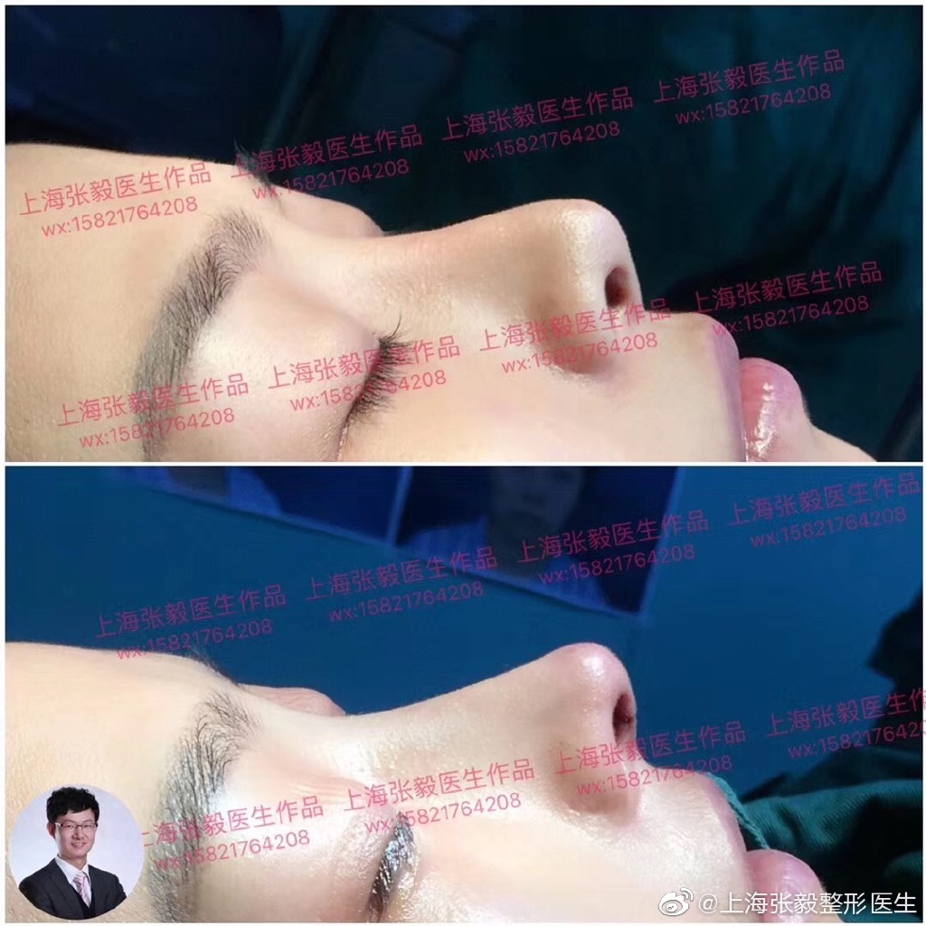 張毅隆鼻案例