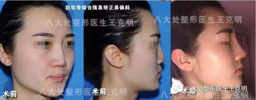 王克明隆鼻修復案例