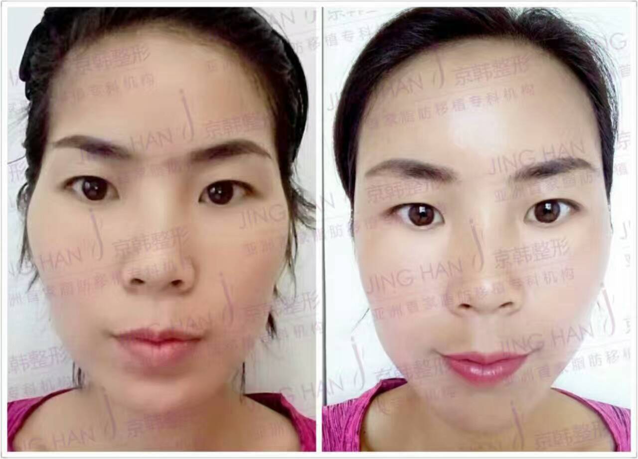 喬愛軍面部脂肪填充案例
