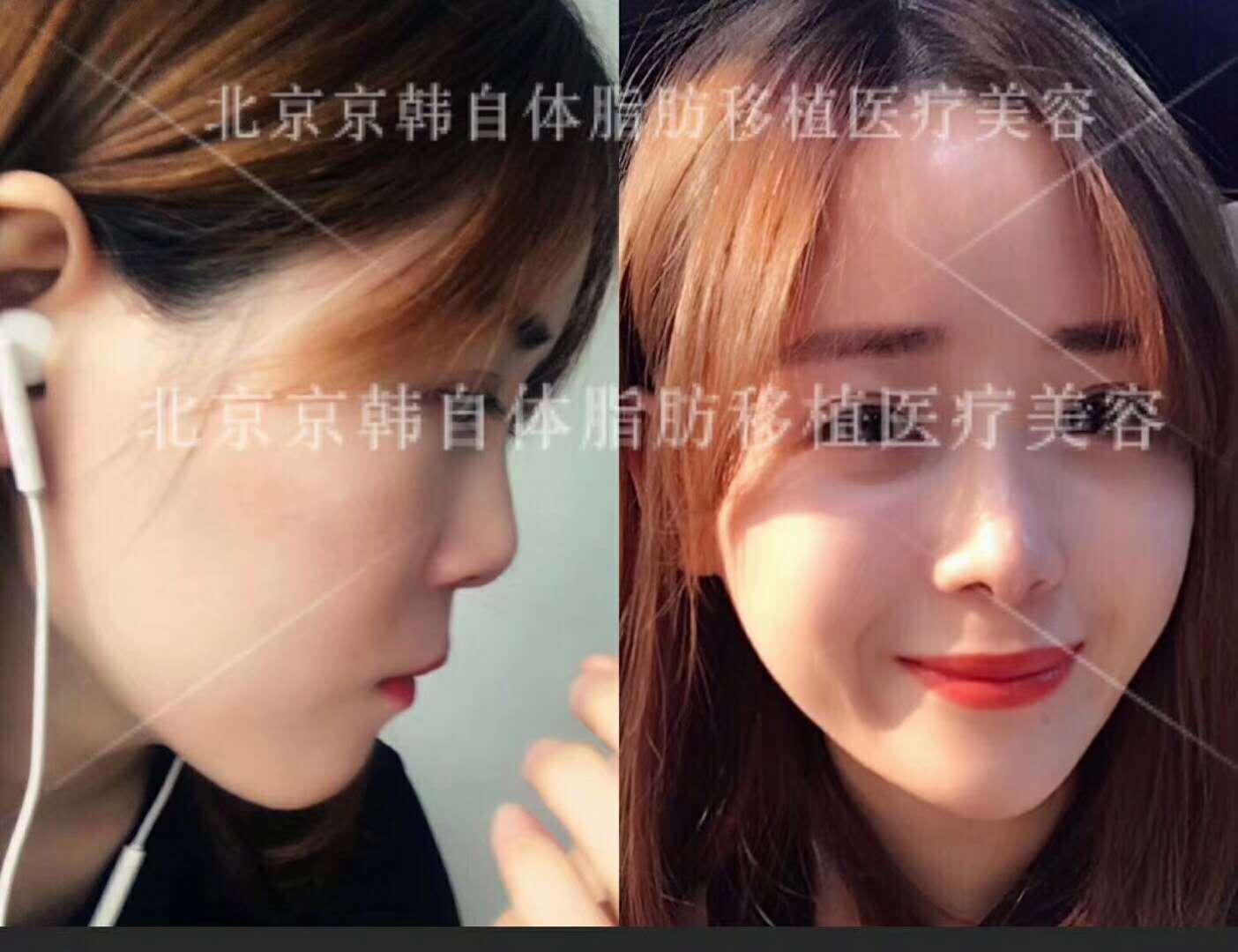 喬愛軍面部脂肪填充案例