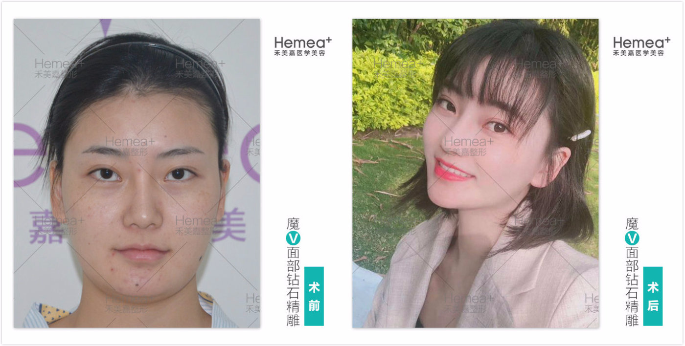 任學會面部精雕案例