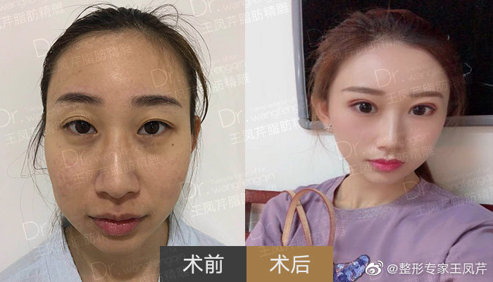 王鳳芹面部填充案例