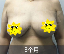 韓嘯乳房下垂提升案例