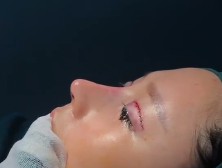 江寶華眼鼻綜合案例