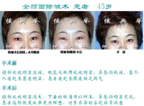 侯典舉面部除皺案例