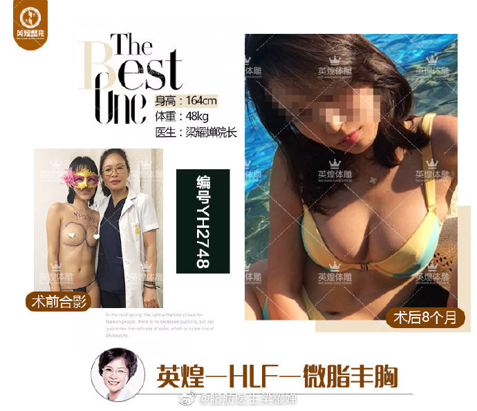 梁耀嬋脂肪豐胸案例
