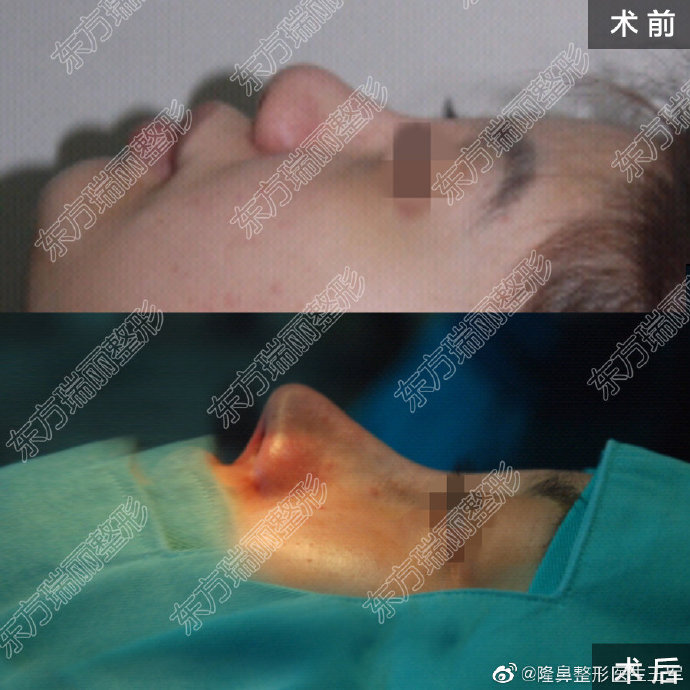 王軍隆鼻案例