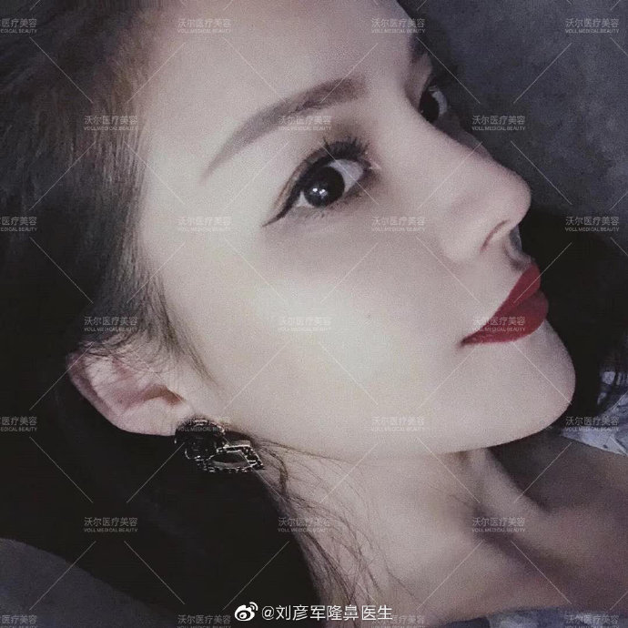 劉彥軍隆鼻案例