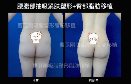 上海豐臀選哪家醫院較好？李健和邱文苑哪個更好？