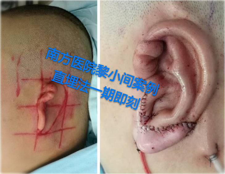 黎小間小耳再造案例