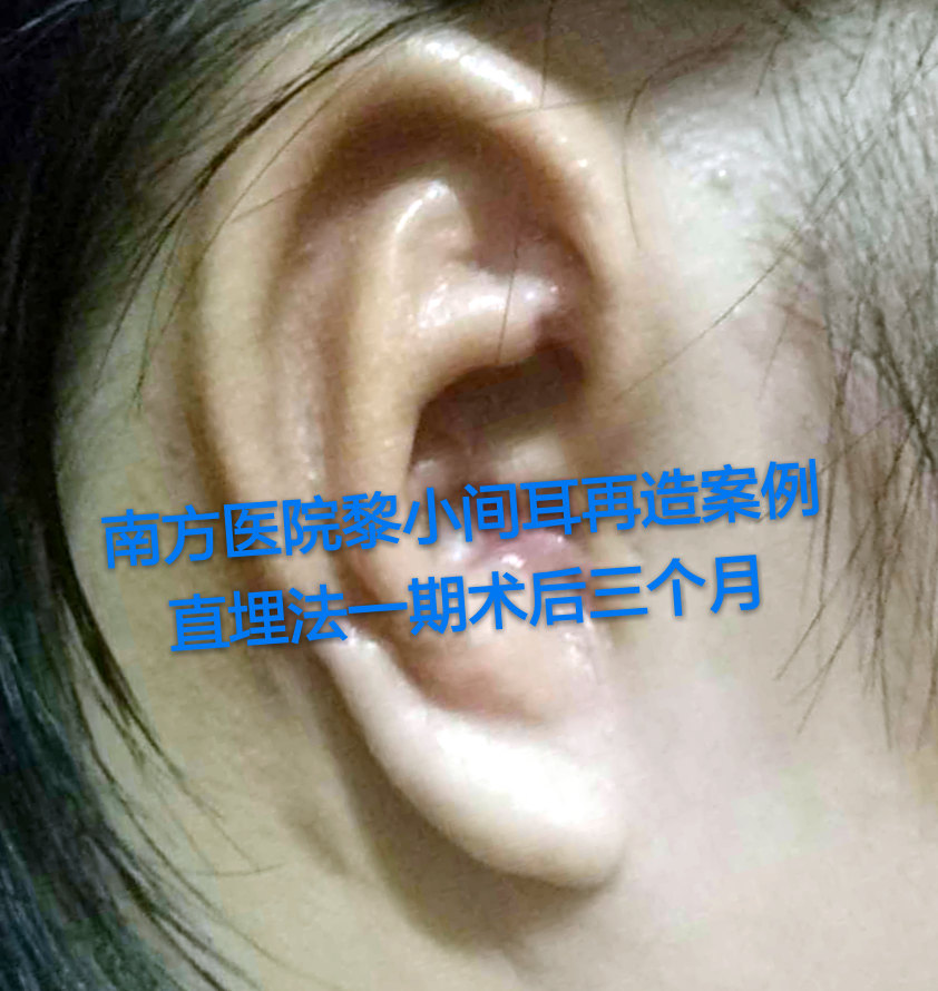黎小間小耳再造案例