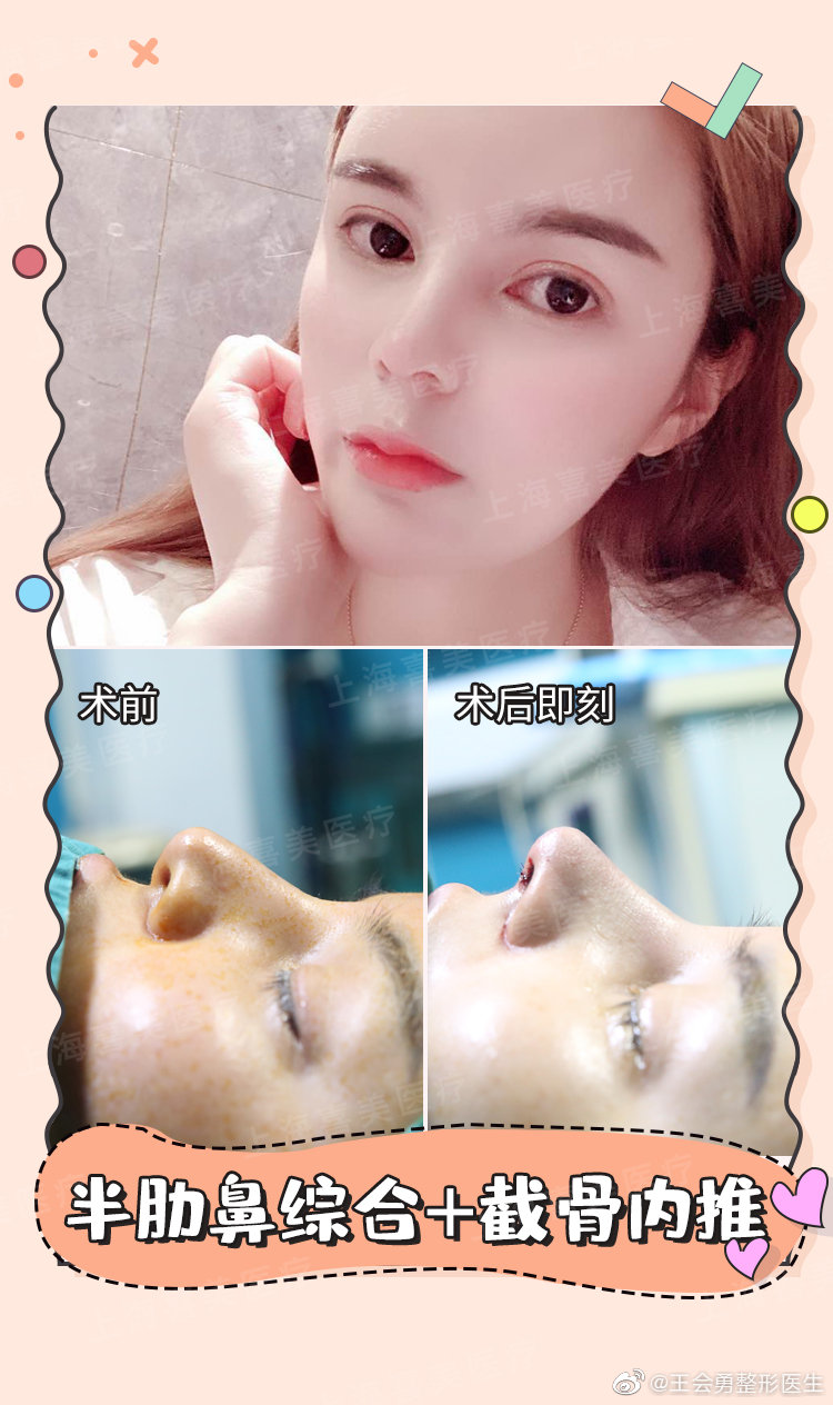 上海最有名氣的鼻王是哪位醫生？