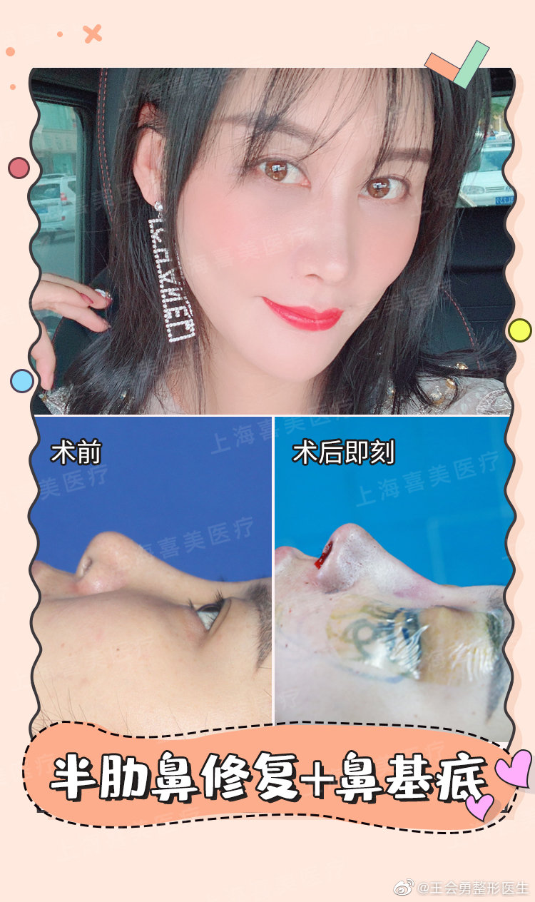 王會勇鼻修復案例