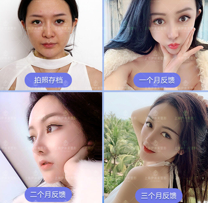 錢玉鑫鼻綜合案例