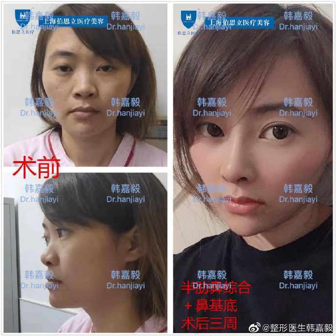 韓嘉毅鼻綜合案例