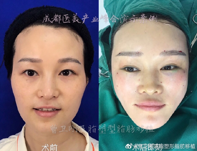 曹衛(wèi)剛面部填充案例