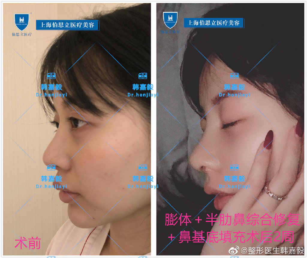 韓嘉毅鼻綜合案例