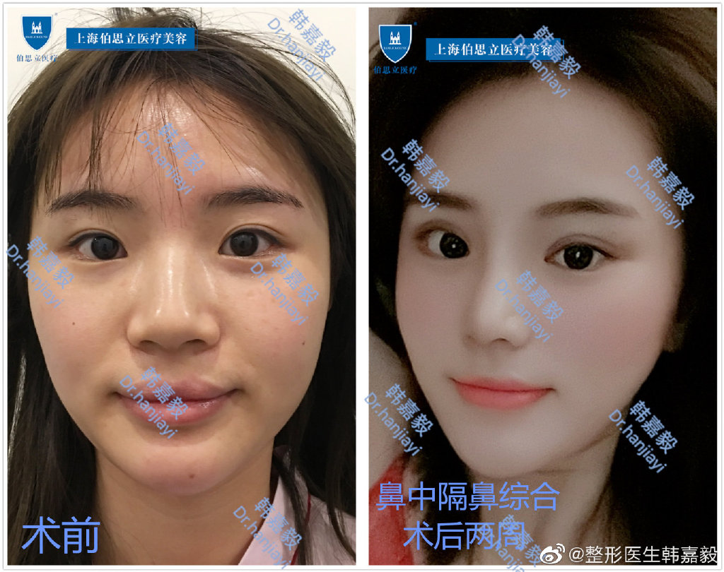 韓嘉毅鼻綜合案例