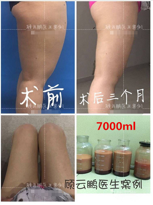 顧云鵬大腿吸脂案例