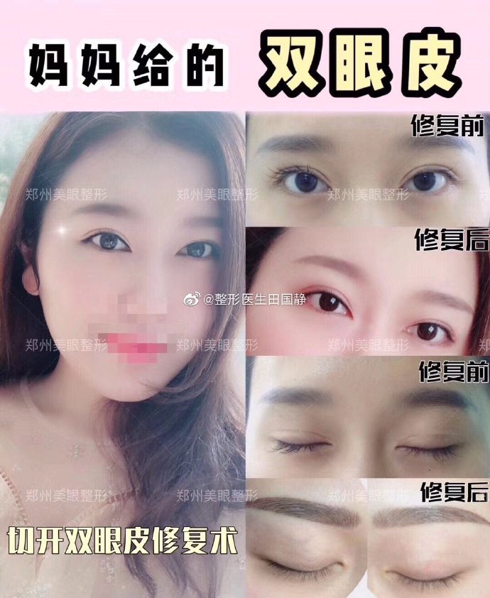 田國靜雙眼皮修復案例
