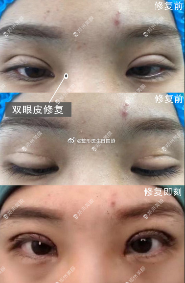 田國靜雙眼皮修復案例