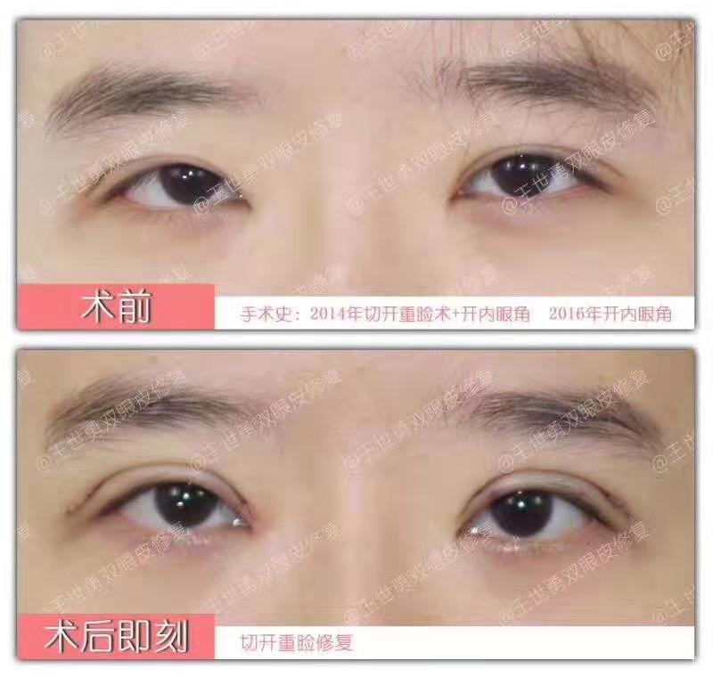 王世勇雙眼皮修復案例