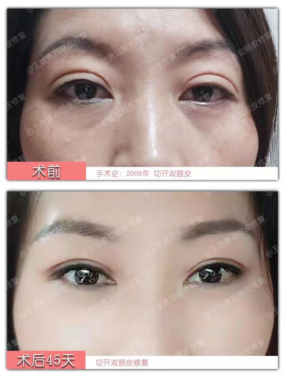 王世勇雙眼皮修復案例