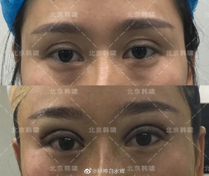 白永輝雙眼皮修復案例