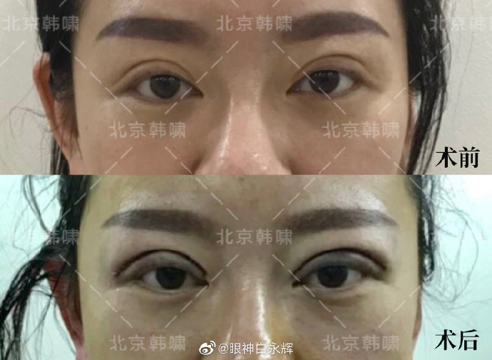 白永輝雙眼皮修復案例