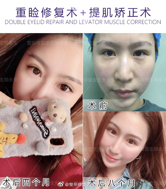 鄭永生雙眼皮修復案例