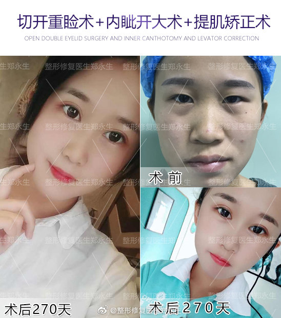 鄭永生雙眼皮修復案例