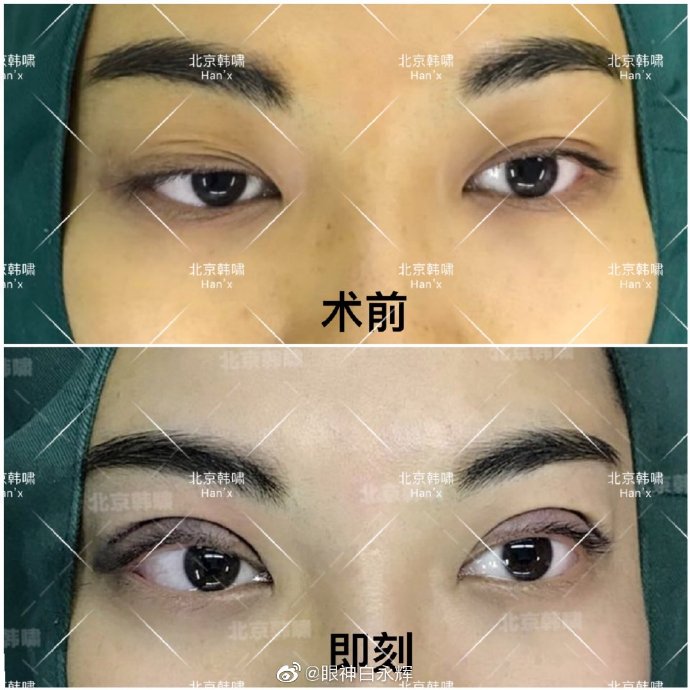 白永輝雙眼皮修復(fù)案例