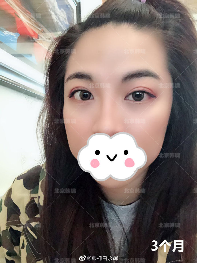 白永輝雙眼皮修復(fù)案例