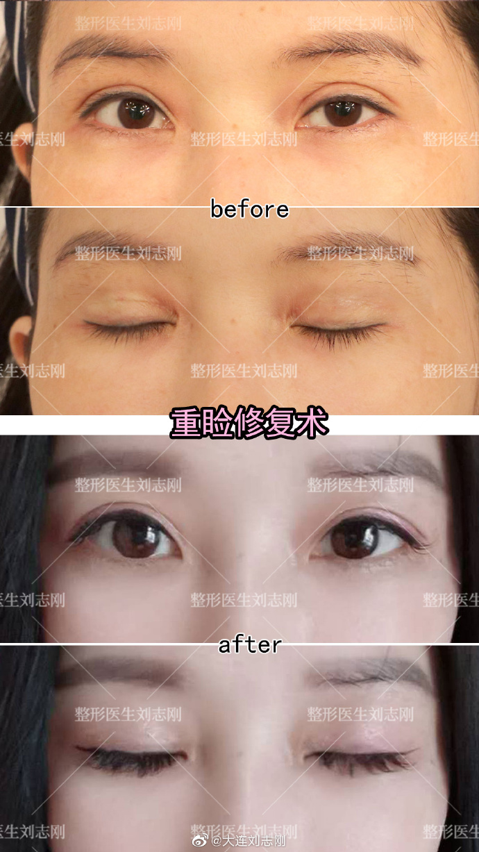 劉志剛雙眼皮修復(fù)案例