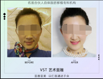 任沖脂肪修復(fù)案例