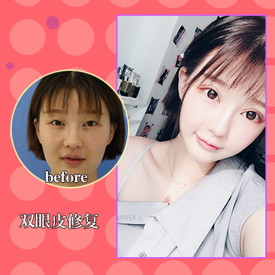 閆迎軍雙眼皮修復案例