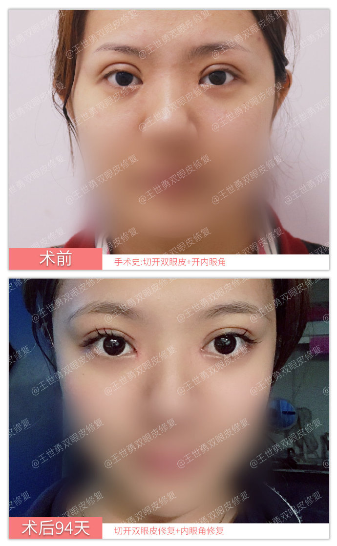 王世勇雙眼皮修復(fù)案例