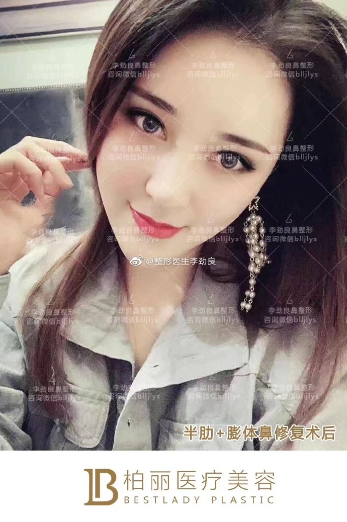 李勁良鼻修復(fù)案例