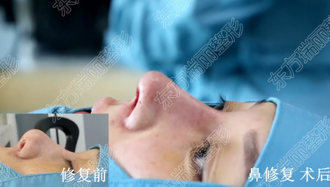 王軍鼻修復(fù)案例