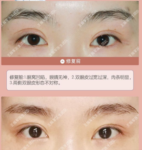 王振軍雙眼皮修復案例