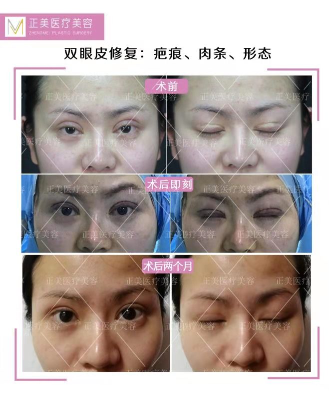 鄭永生雙眼皮修復案例